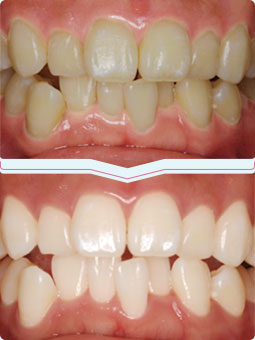 ホワイトニング：歯の内側から白くします